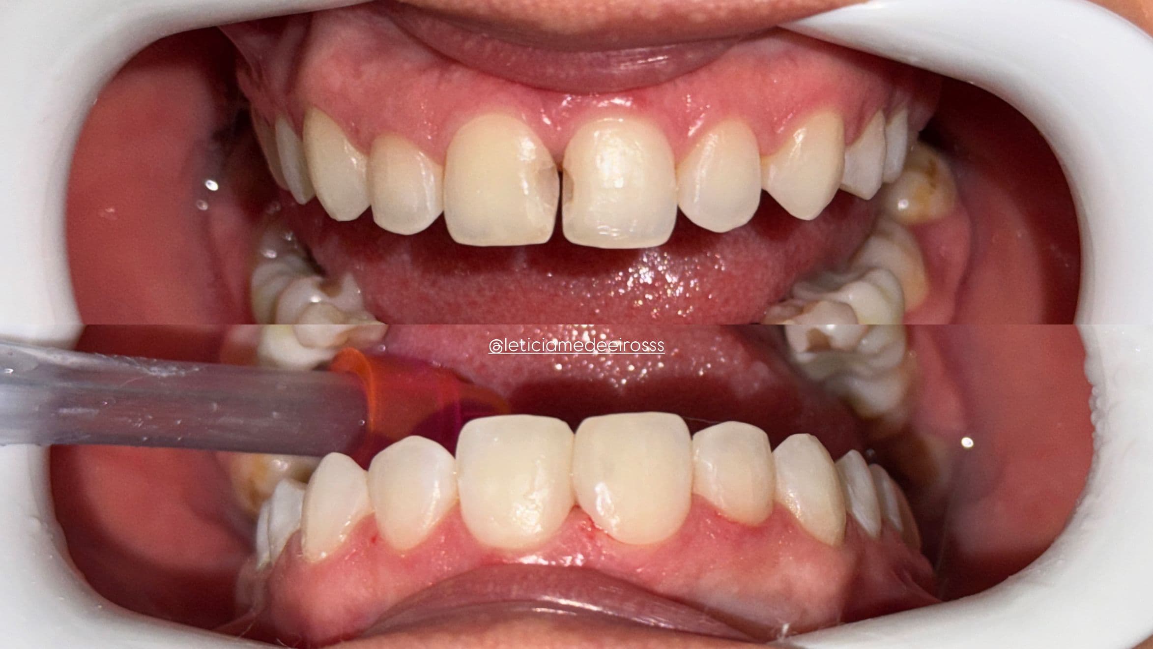 Caso de facetas antes e depois - vista frontal