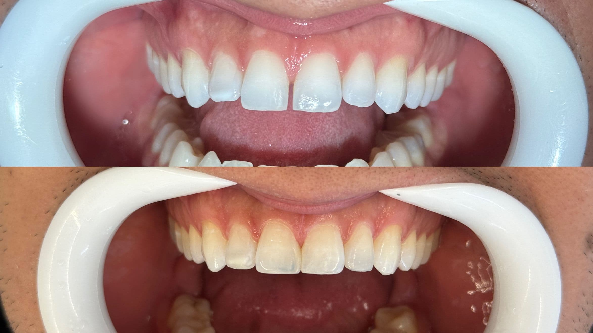 Caso de facetas antes e depois - vista lateral