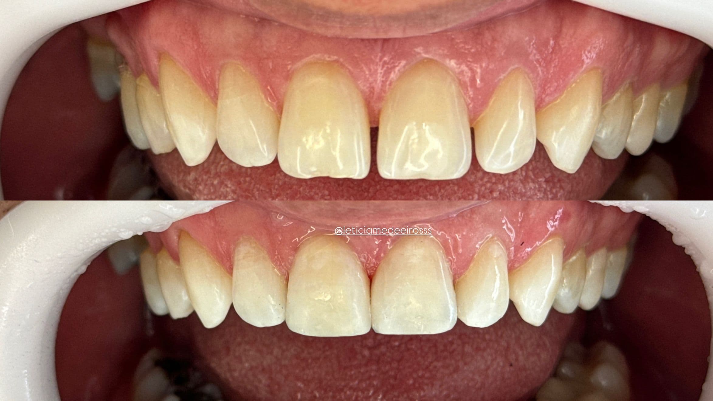 Caso de facetas antes e depois - detalhe dos dentes