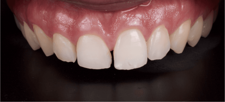 Detalhe frontal das facetas finalizadas