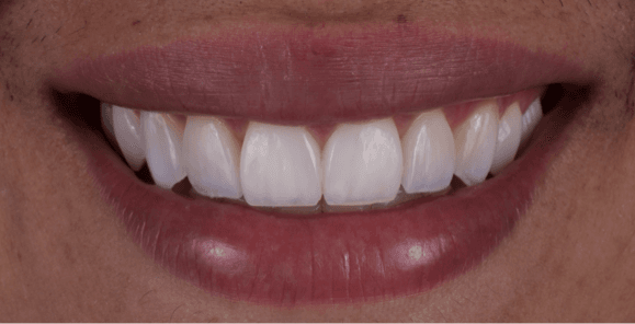 Sorriso completo do paciente após as facetas