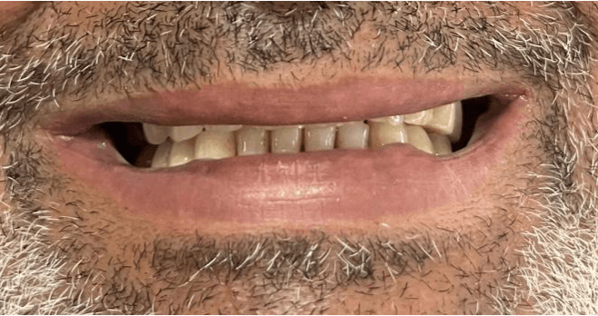 Antes da reabilitação: dentes desgastados e amarelados