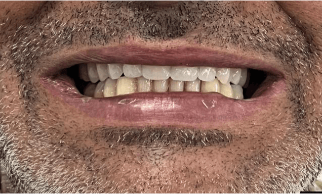 Caso real de reabilitação sobre implantes - sorriso reconstruído