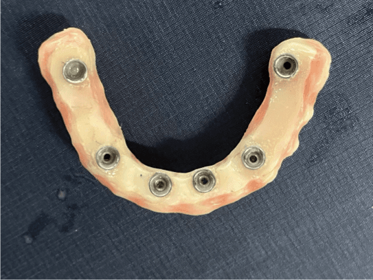 Caso real - prótese protocolo sobre implantes