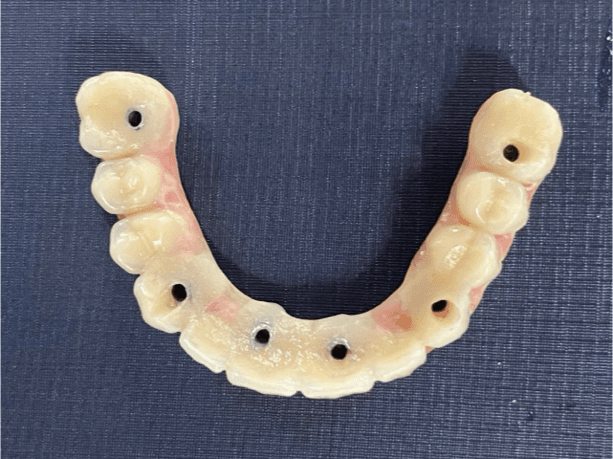 Vista oclusal da prótese protocolo confeccionada