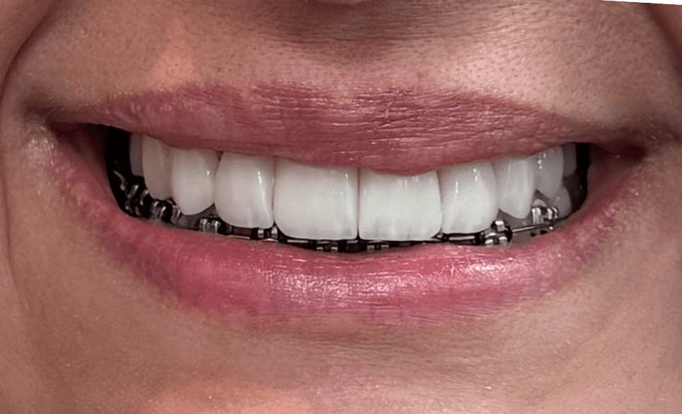 Sorriso frontal de paciente da Allianza após facetas dentárias