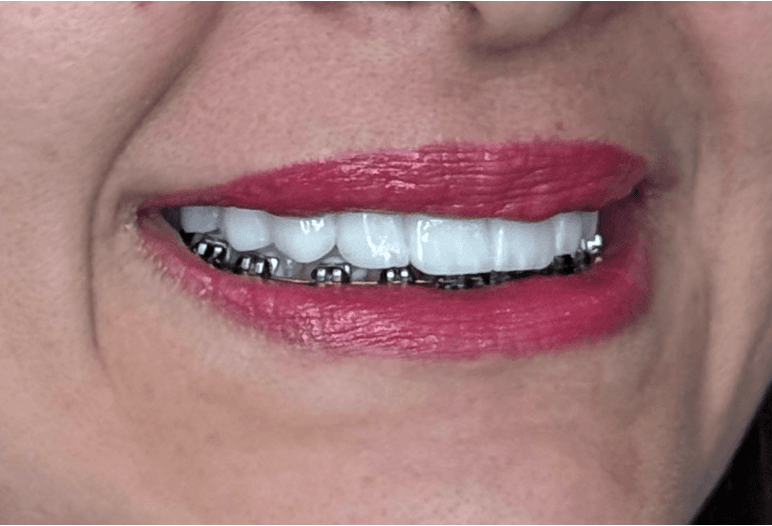 Sorriso de paciente da Allianza visto de frente