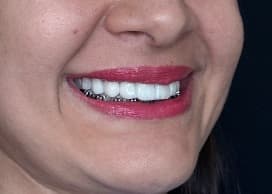 Sorriso natural de paciente da Allianza após facetas dentárias