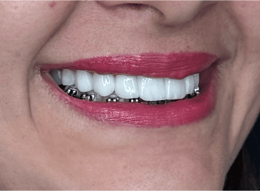 Sorriso de paciente da Allianza visto de lado